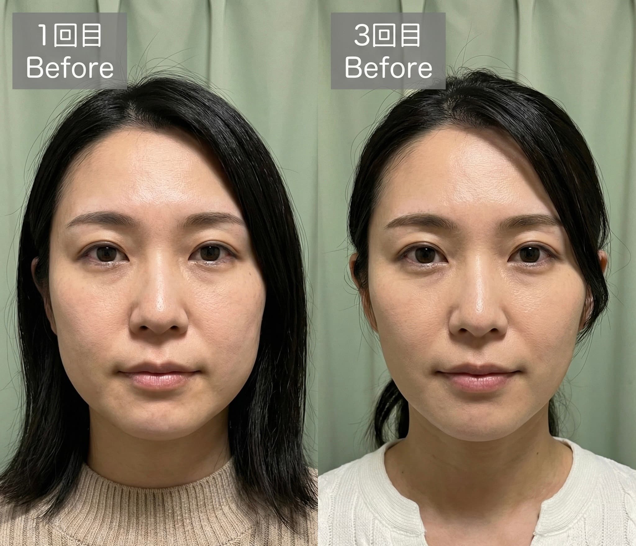 体重 −5.8kg / 体脂肪率 −4.2% ビフォーアフター